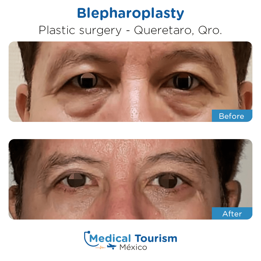 plastic surgery before and after of patients
                 in Querétaro