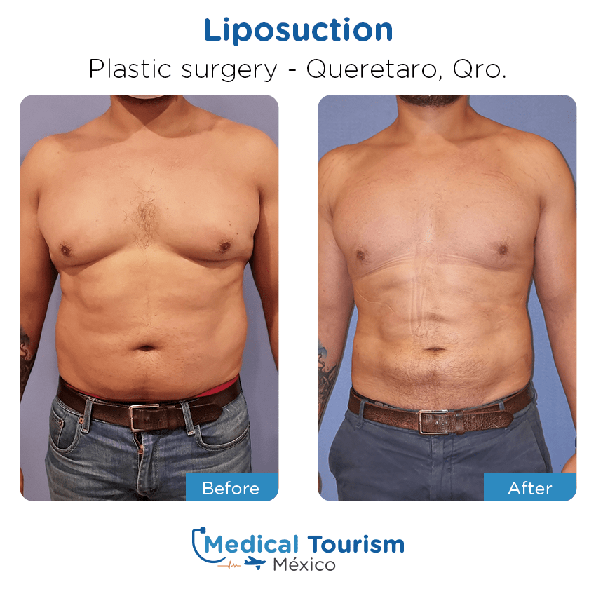 plastic surgery before and after of patients in Querétaro