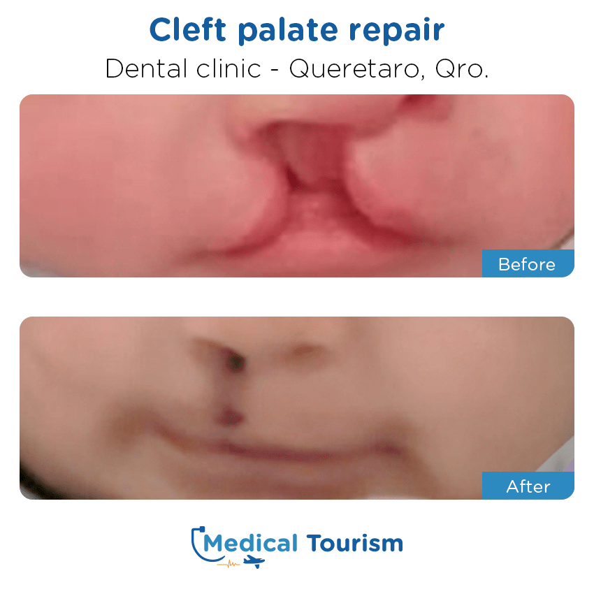 dental before and after of patients in Querétaro
