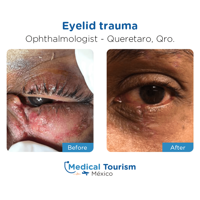 ophthalmology before and after of patients in Querétaro