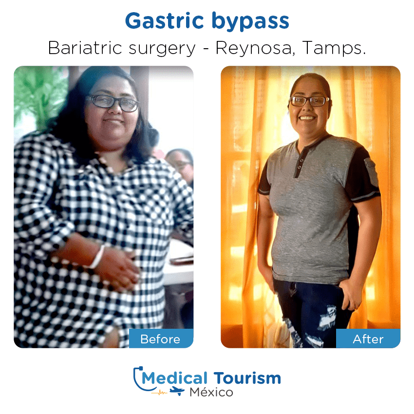 bariatric surgery before and after of patients
                 in Reynosa