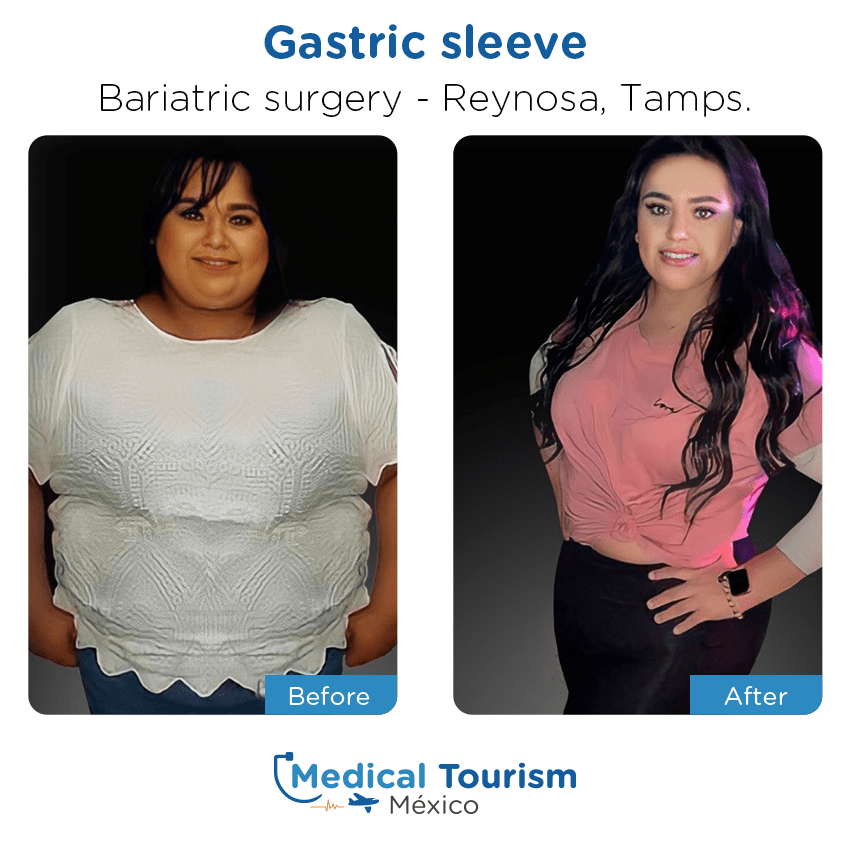 bariatric surgery before and after of patients
                 in Reynosa