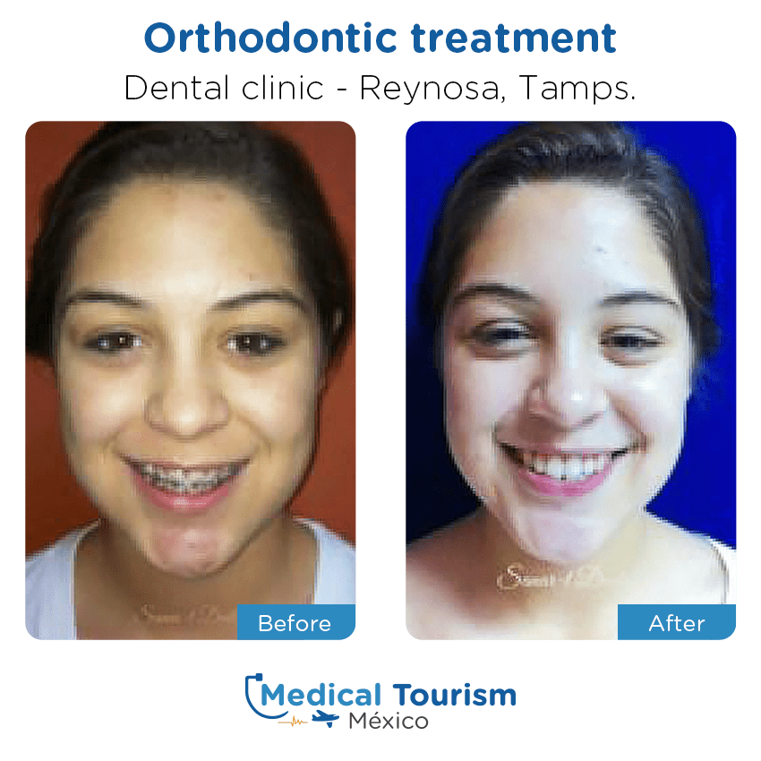 dental before and after of patients
                 in Reynosa
