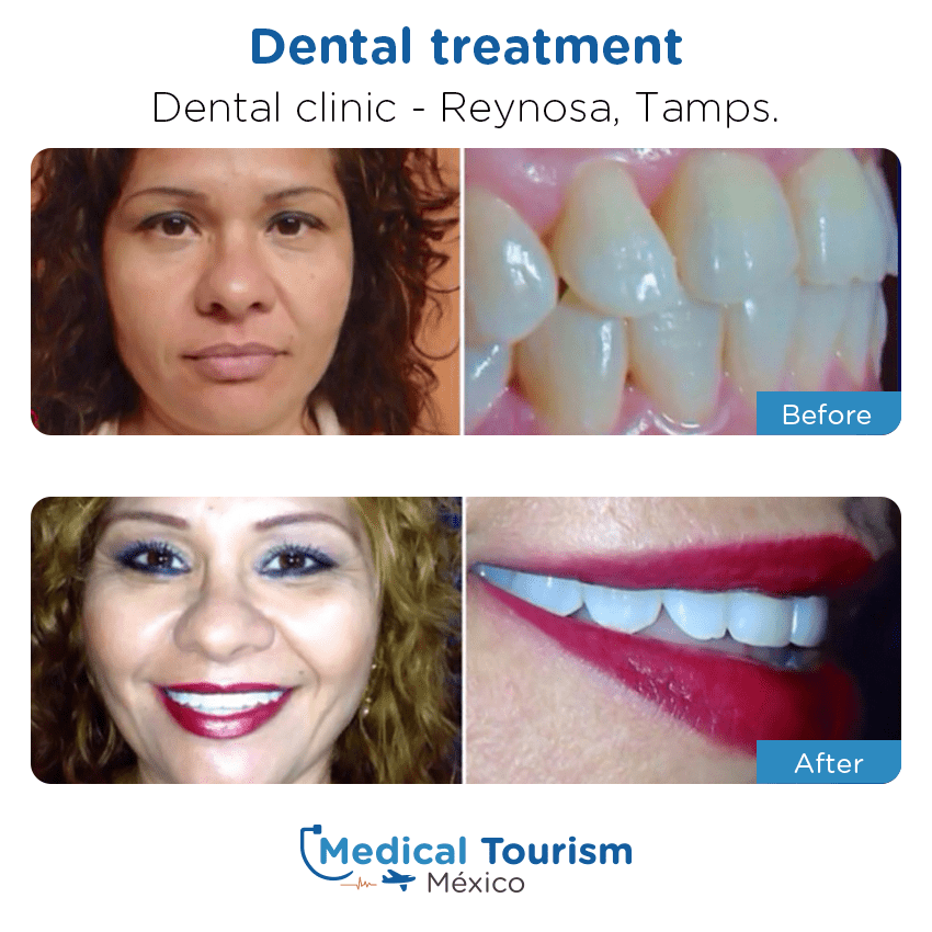 dental before and after of patients
                 in Reynosa