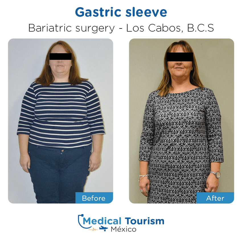 bariatric surgery before and after of patients
                 in Los Cabos