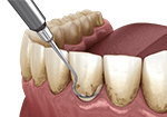 Removing dental plaque with teeth scaling