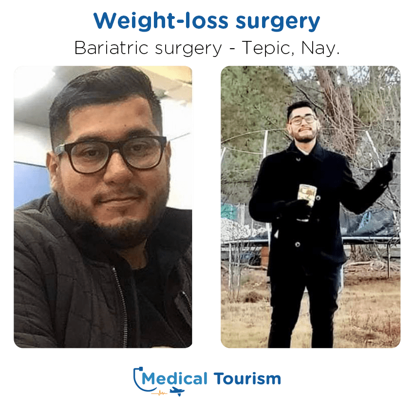 bariatric surgery before and after of patients in Tepic