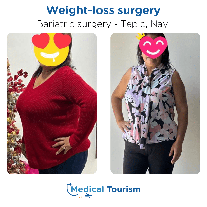 bariatric surgery before and after of patients in Tepic