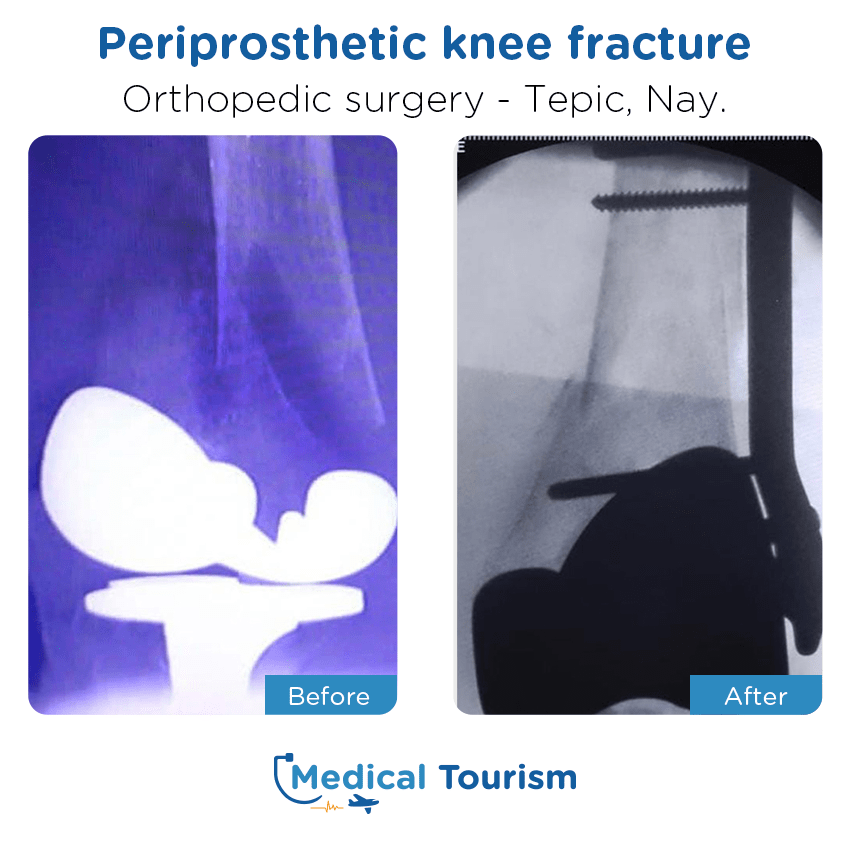orthopedic before and after of patients in Tepic