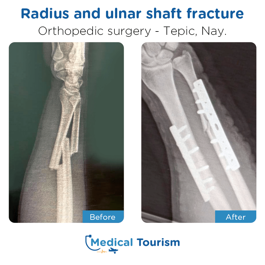 orthopedic before and after of patients in Tepic