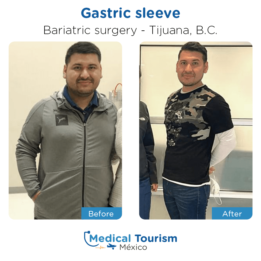 bariatric surgery before and after of patients in Tijuana