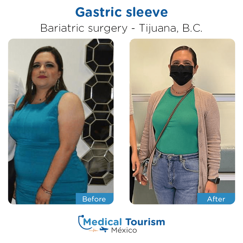bariatric surgery before and after of patients
                 in Tijuana