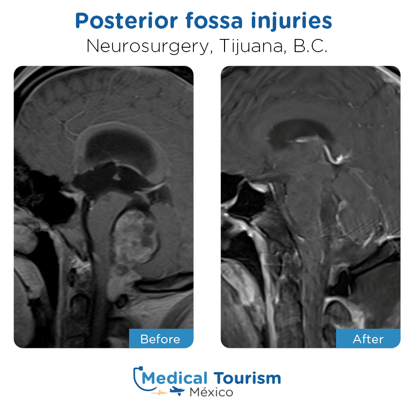 neurosurgery before and after of patients
                 in Tijuana