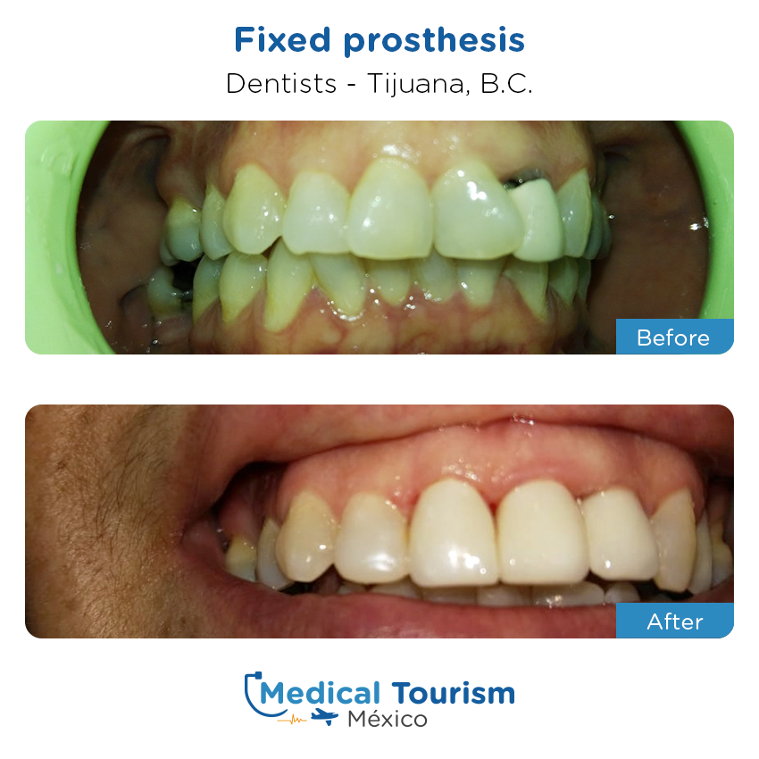 dental before and after of patients
                 in Tijuana
