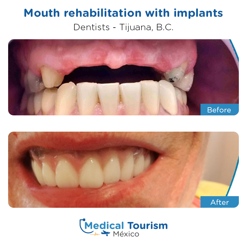 dental before and after of patients in Tijuana