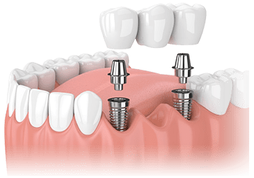 Illustrative image for snap on dentures procedure 