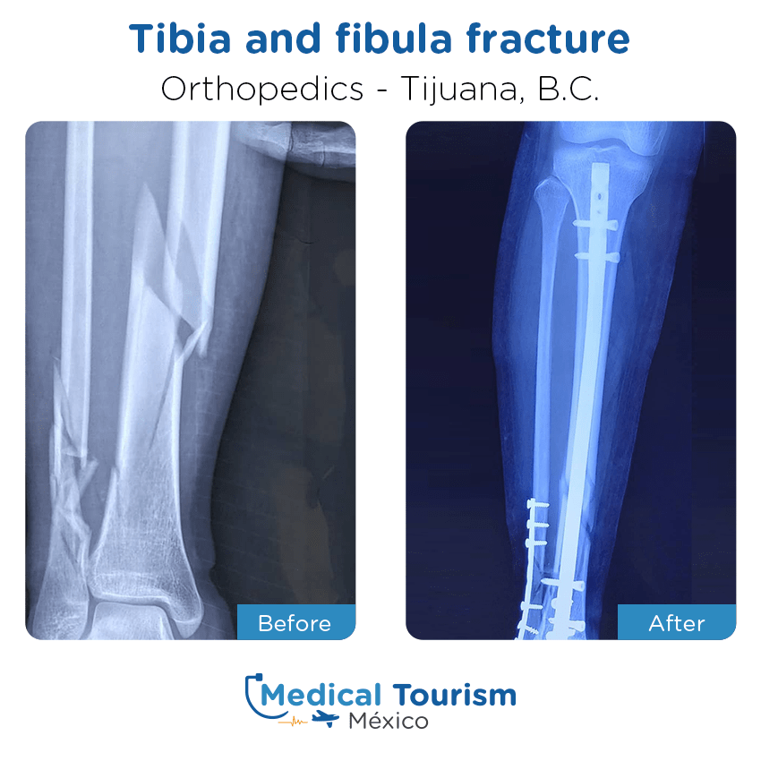orthopedic before and after of patients in Tijuana
