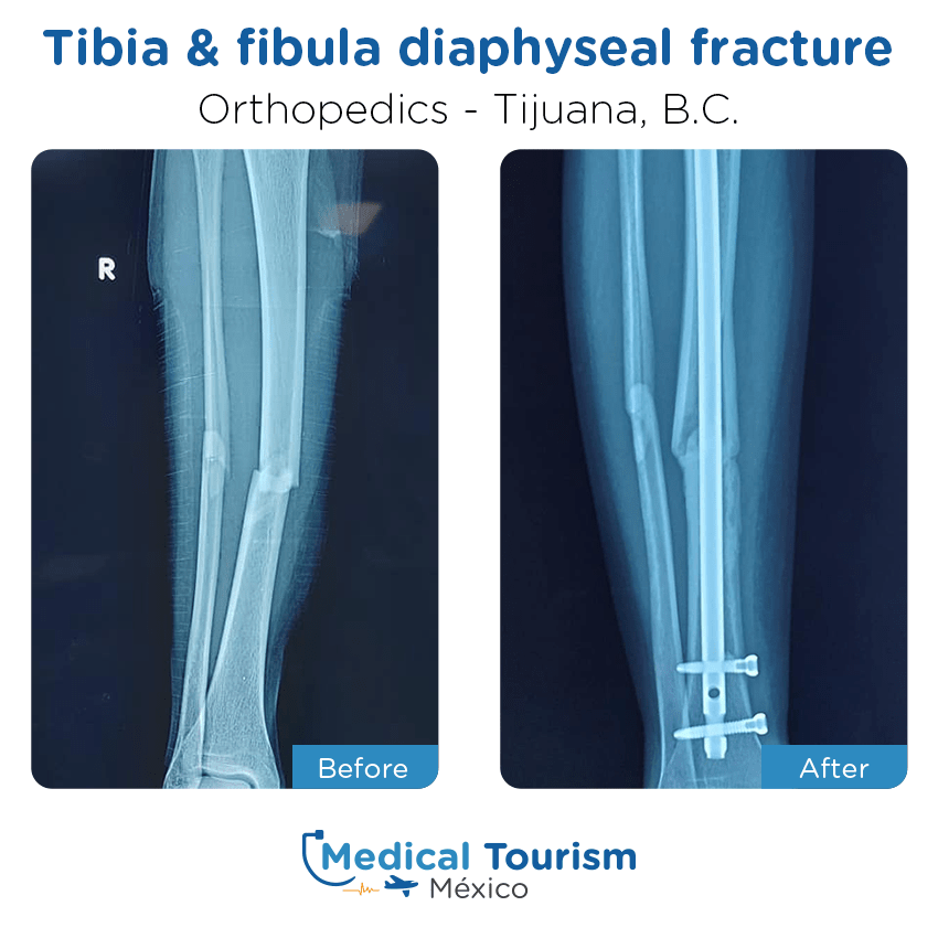orthopedic before and after of patients
                 in Tijuana