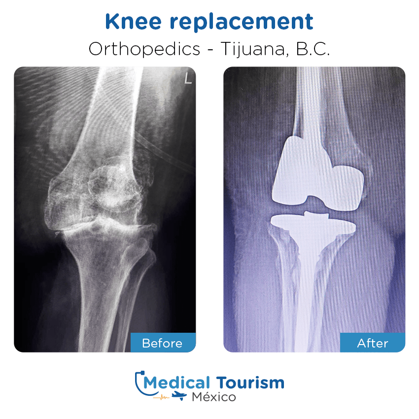 orthopedic before and after of patients
                 in Tijuana