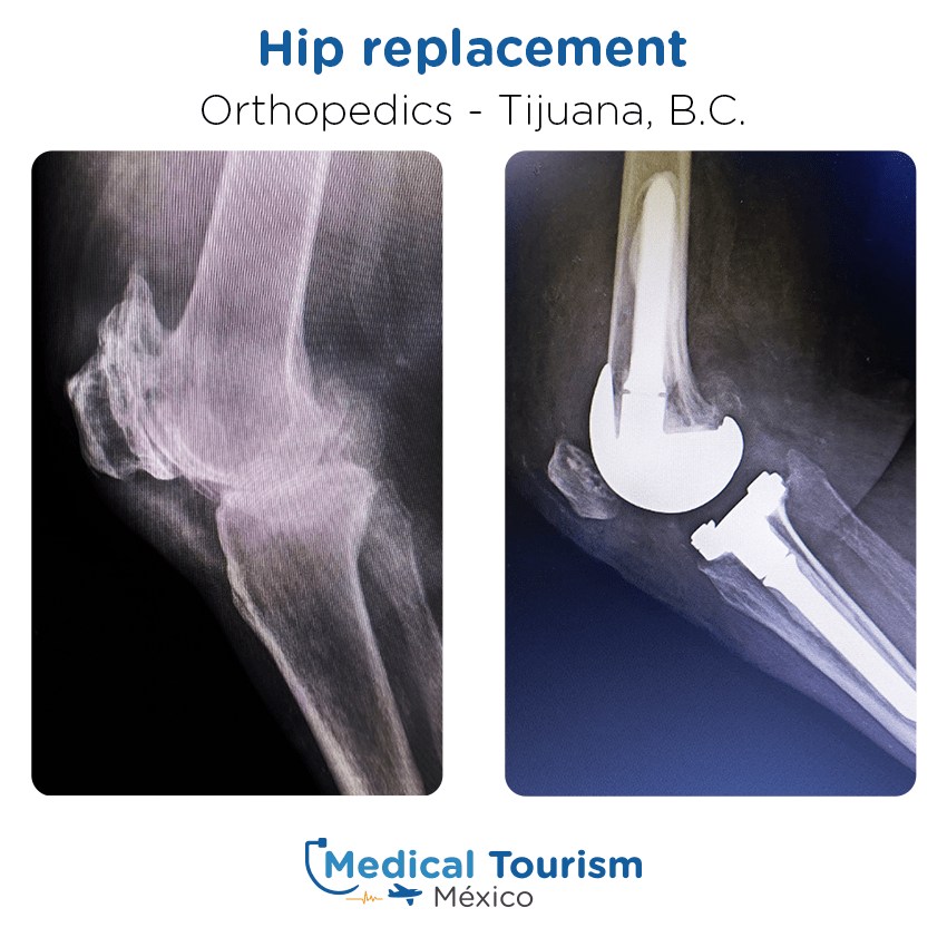 orthopedic before and after of patients in Tijuana