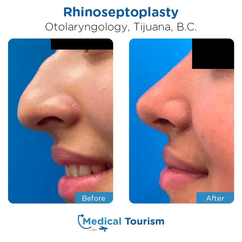 otolaryngology - ENT before and after of patients in Tijuana