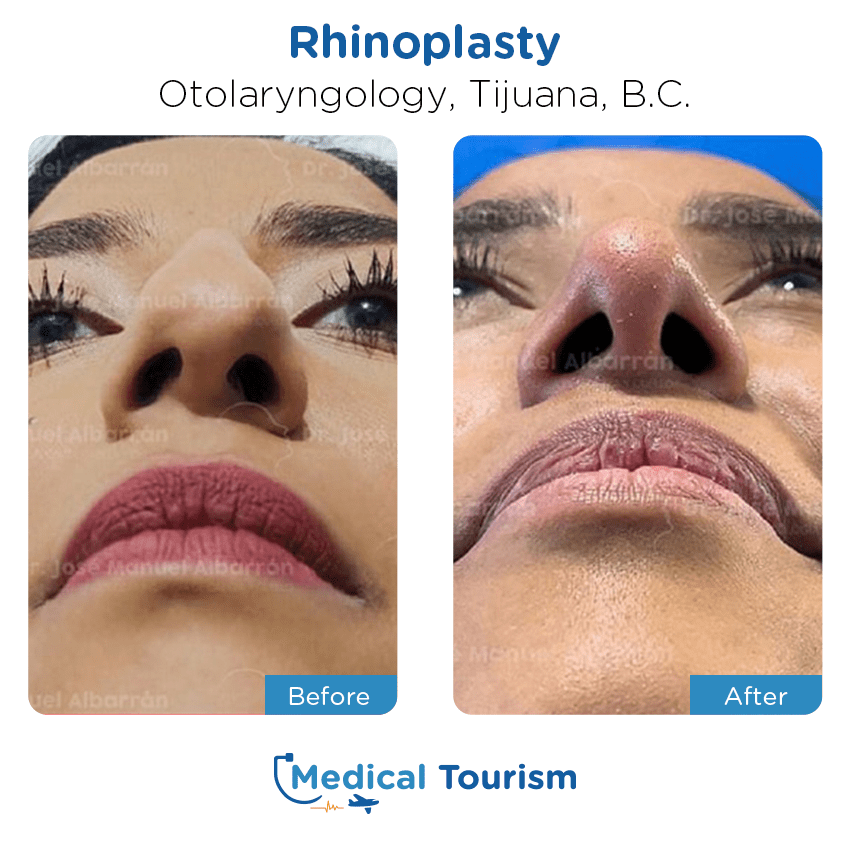 otolaryngology - ENT before and after of patients in Tijuana