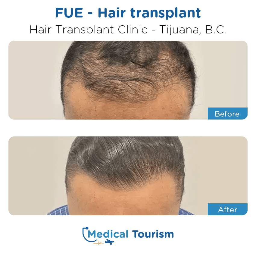 hair transplant clinic  before and after of patients in Tijuana