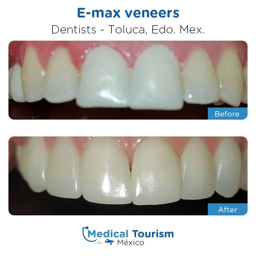 dental before and after of patients
                 in Toluca