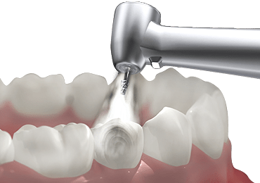 illustrative image of endodontics procedure