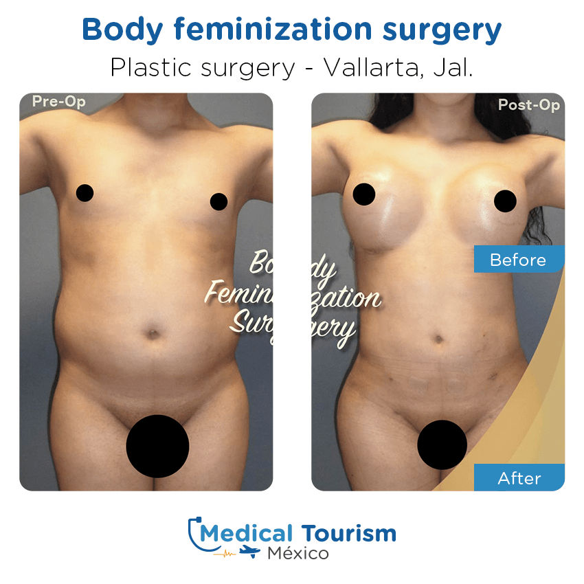 plastic surgery before and after of patients in Vallarta