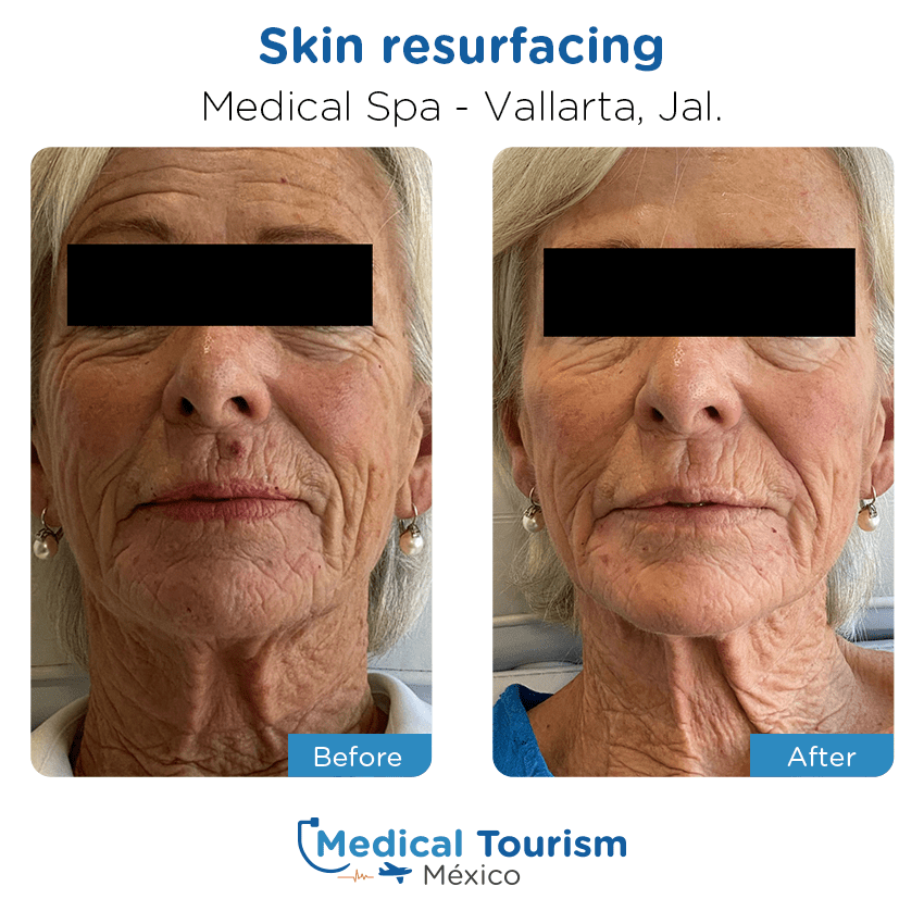aesthetic medicine before and after of patients
                 in Vallarta