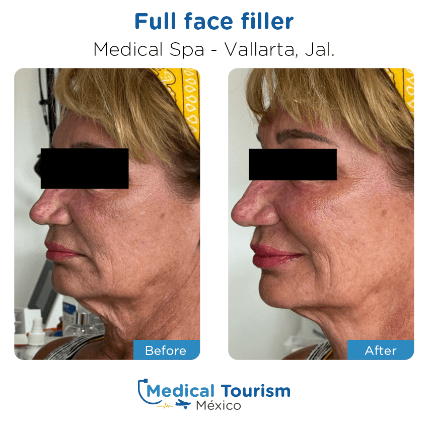 aesthetic medicine before and after of patients
                 in Vallarta